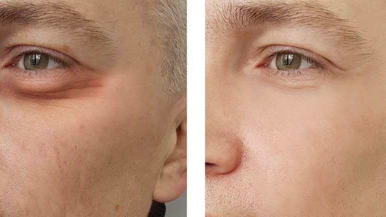 Blefaroplastia na pálpebra inferior