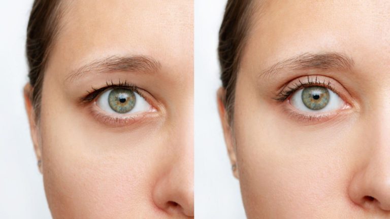 Blefaroplastia na pálpebra superior